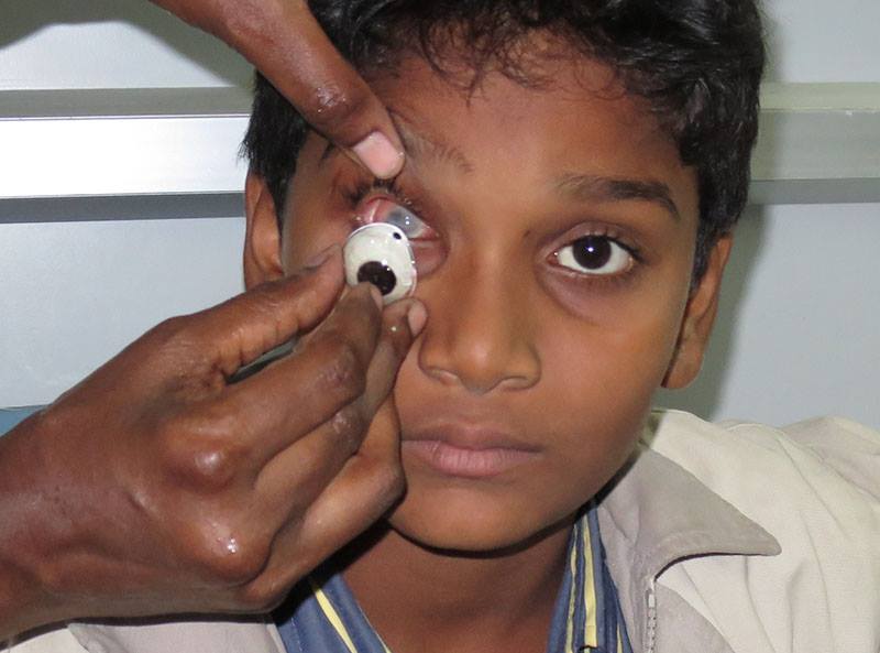 ocular prosthetic