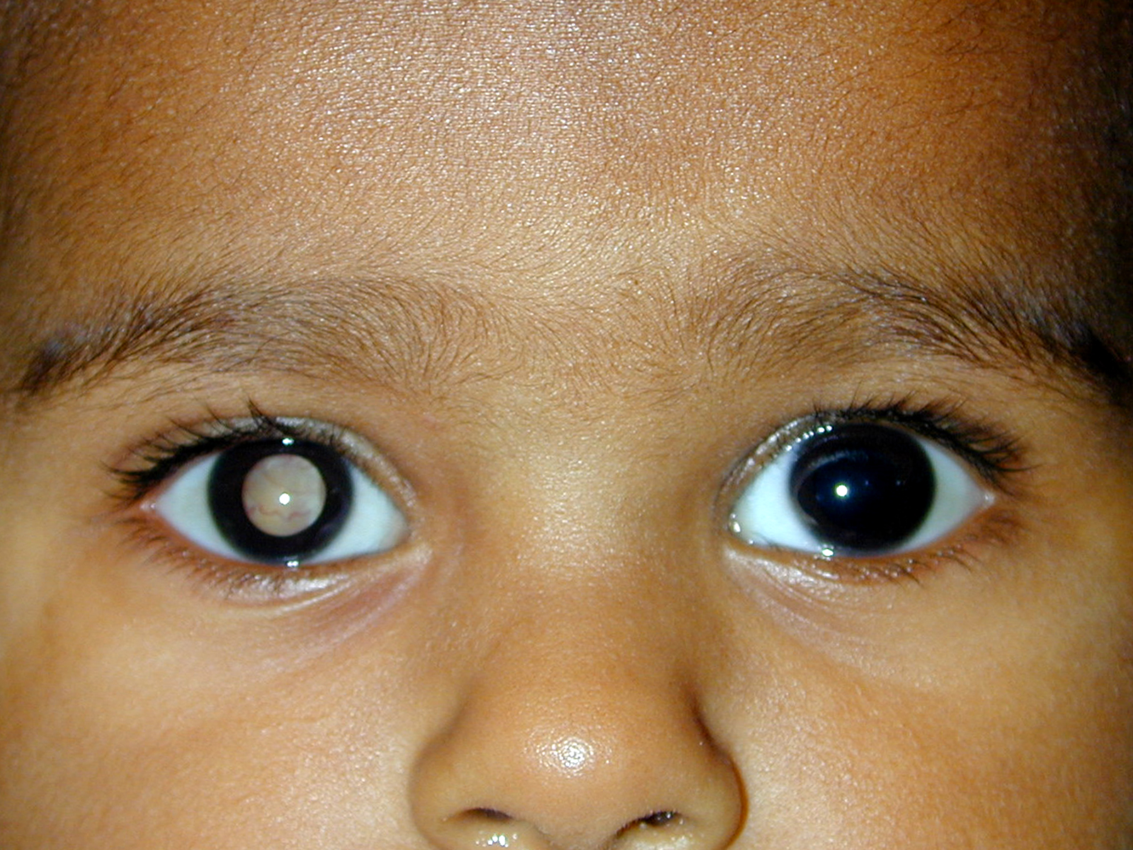Глаза признак. Орбитальная ретинобластома. Ретинобластома (рак сетчатки). Бинокулярная ретинобластома. Врожденная катаракта ретинобластома.