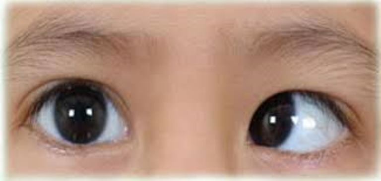 Cross-Eyed Baby (Strabismus): Causes and Treatment