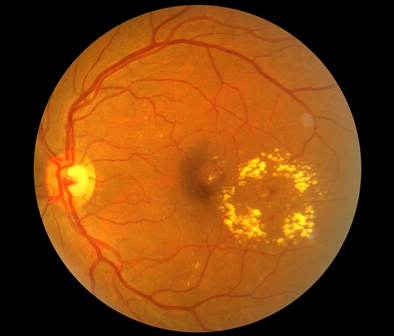 Diabetic Retinopathy - Aravind Eye Care System