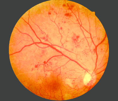 Diabetic Retinopathy - Aravind Eye Care System